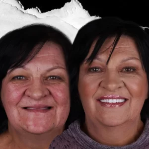 before-after-dental-implant-1 (2)
