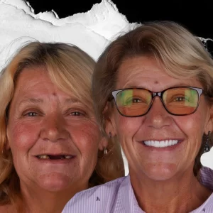 before-after-dental-implant-4 (2)