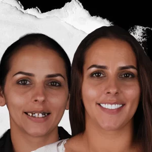 before-after-dental-implant-5
