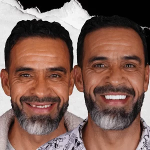 before-after-dental-implant-6
