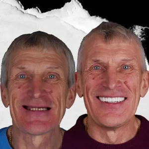 before-after-dental-implant-7