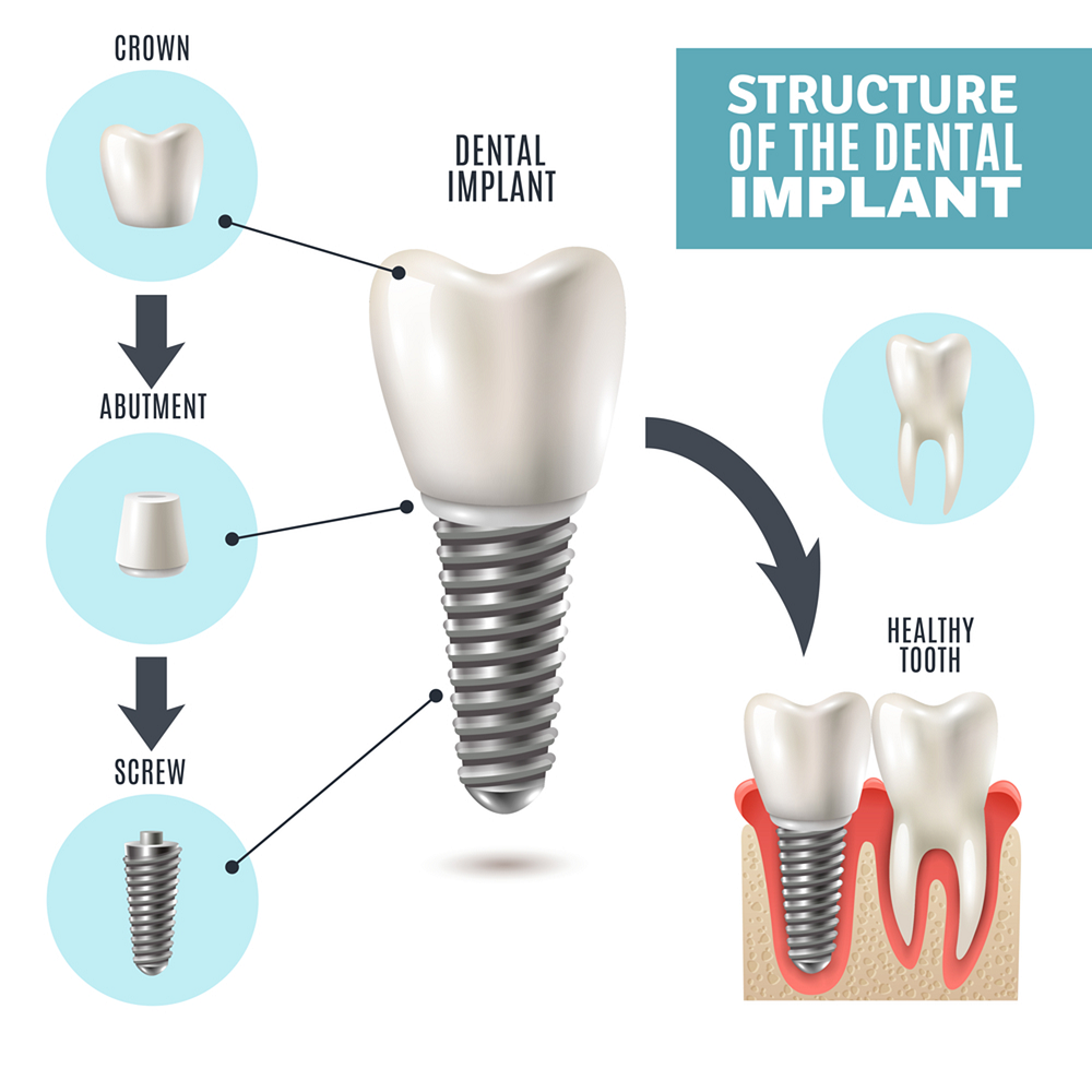 what to expect during the dental implant procedure