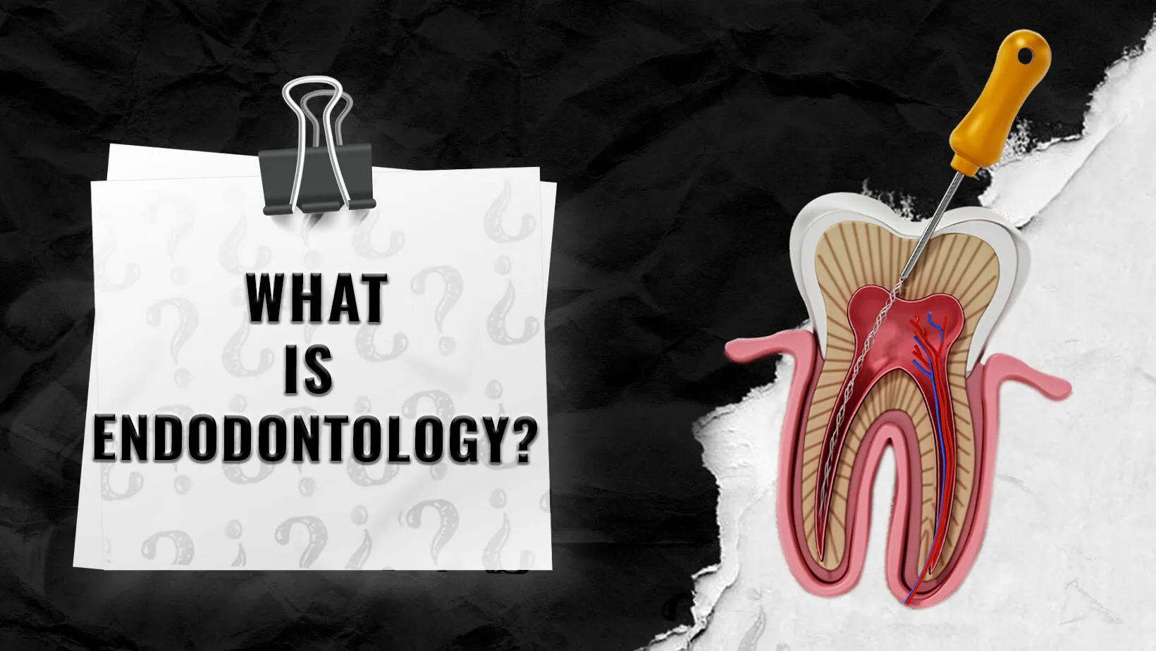 Endodontics in IstanbulTurkey