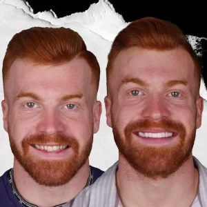 before-after-Dental-Crowns-6