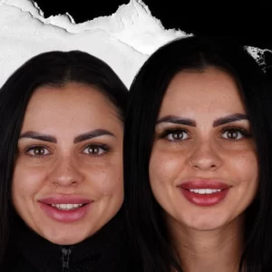 before-after-Digital-Smile-Design-2
