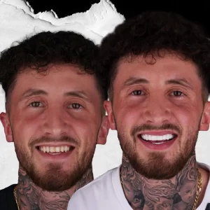 before-after-Digital-Smile-Design-4