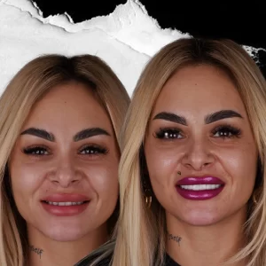 before-after-Digital-Smile-Design-5