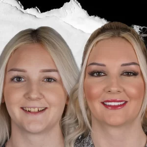before-after-Hollywood-Smile-1