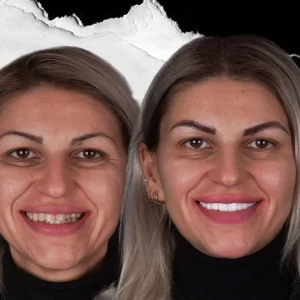 before-after-Hollywood-Smile-3