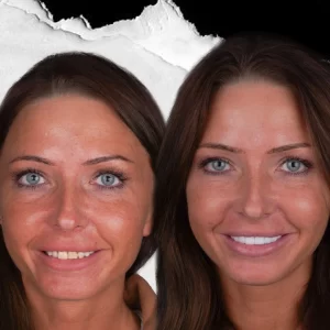 before-after-Hollywood-Smile-4