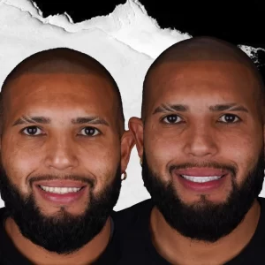 before-after-Hollywood-Smile-5