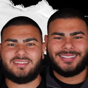 before-after-Hollywood-Smile-6