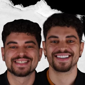 before-after-Hollywood-Smile-7