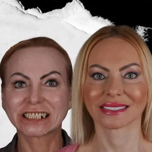 before-after-Hollywood-Smile-8