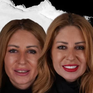 before-after-Hollywood-Smile-9