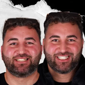 before-after-Teeth-Whitening-1