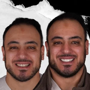 before-after-Teeth-Whitening-2