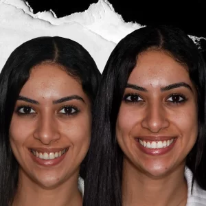 before-after-Teeth-Whitening-3