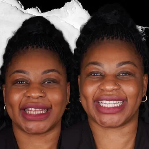 before-after-Teeth-Whitening-5