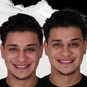 before-after-Teeth-Whitening-7