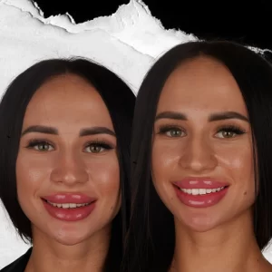 before-after-Teeth-Whitening-9