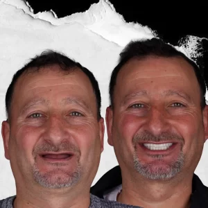 before-after-dental-implant-1 (3)