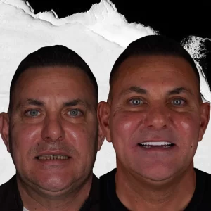 before-after-dental-implant-3 (1)