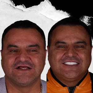 before-after-dental-implant-4 (4)