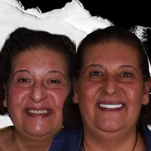 before-after-dental-implant-5 (1)