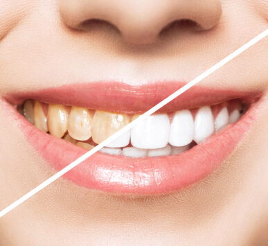 woman teeth before and after whitening. Over white background. Dental clinic patient. Image symbolizes oral care dentistry, stomatology.